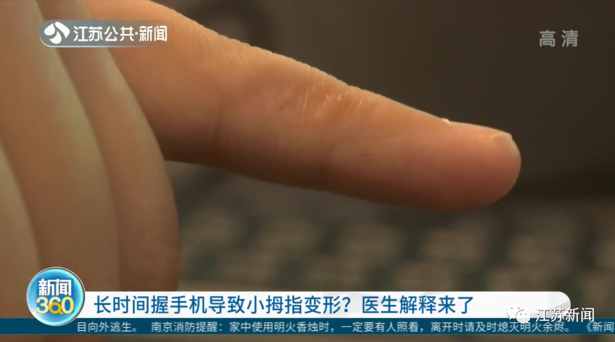 你会用小拇指托住手机吗？收下这则医生提醒！