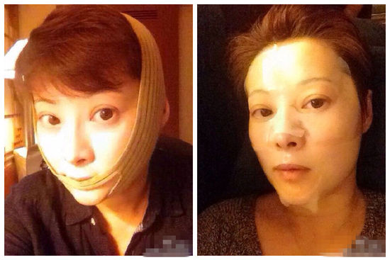 袁立晒照敷面膜缠瘦脸绷带 　为V字脸也是蛮拼的