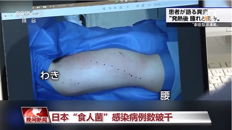 容易被误诊为感冒，日本“食人菌”感染破千！发病到休克最快只需24小时