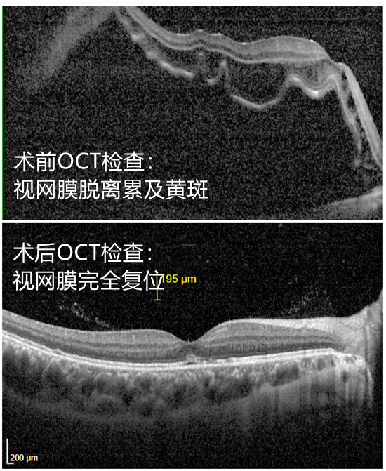 高考临近，福建一考生眼里出现马赛克，视力骤降！福州爱尔眼科启动绿色通道紧急施救 